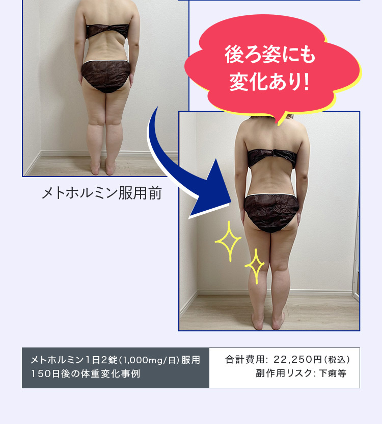 後ろ姿にも変化あり! メトホルミン服用前 メトホルミン1日2錠(1,000mg/日)服用 150日後の体重変化事例 合計費用:22,250円(税込) 副作用リスク:便秘等